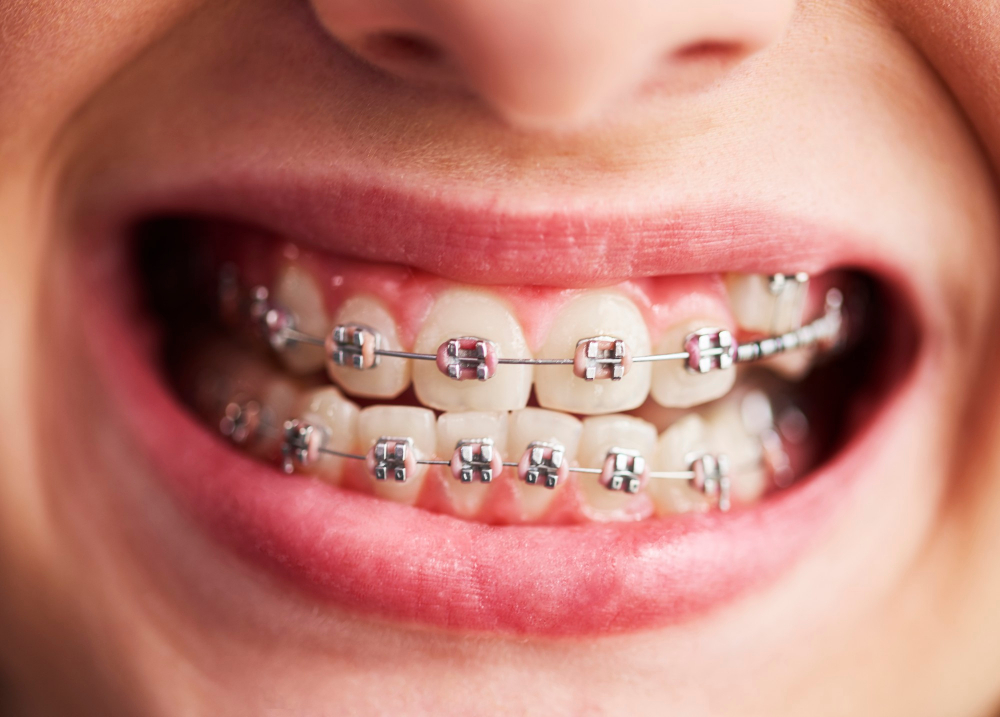 Best Orthodontist in Kolkata | Orthodontic Treatment | Braces Cost